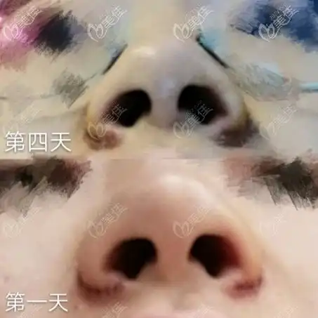  切开鼻孔法鼻翼缩小介绍切开鼻孔法鼻翼缩小价格切开鼻孔法鼻翼缩小副作用切开鼻孔法鼻翼缩小优缺点美佳网