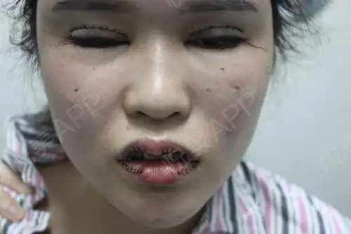  姐妹们下午好小新人一枚,来跟大家分享一下我的整...眼部多项悦美整形
